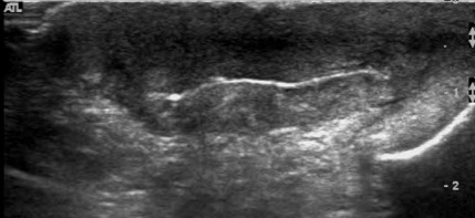 Figure 4 for case Hidradenitis suppurativa